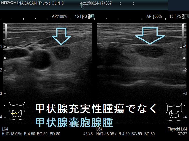 甲状腺充実性腫瘍でなく甲状腺のう胞腺腫(甲状腺嚢胞腺腫) 甲状腺充実性腫瘍でなく甲状腺のう胞腺腫(甲状腺嚢胞腺腫)1
