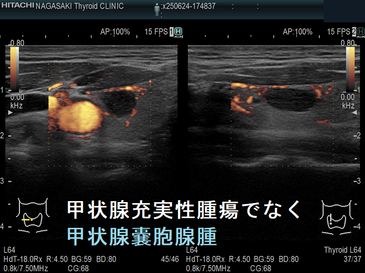 甲状腺充実性腫瘍でなく甲状腺のう胞腺腫(甲状腺嚢胞腺腫)ドプラーモード 甲状腺充実性腫瘍でなく甲状腺のう胞腺腫(甲状腺嚢胞腺腫)ドプラーモード