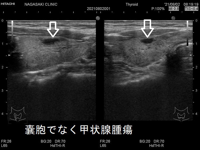 甲状腺嚢胞でなく甲状腺腫瘍 甲状腺嚢胞でなく甲状腺腫瘍