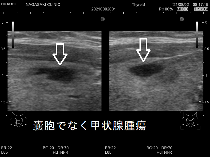 甲状腺嚢胞でなく甲状腺腫瘍 甲状腺嚢胞でなく甲状腺腫瘍