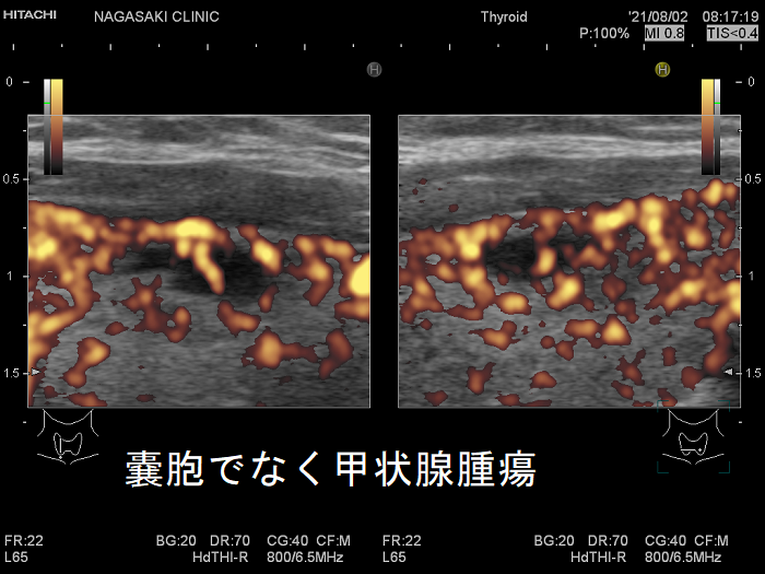 甲状腺嚢胞でなく甲状腺腫瘍 ドプラー 甲状腺嚢胞でなく甲状腺腫瘍 ドプラー
