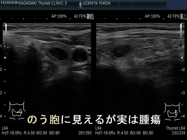 甲状腺のう胞に見えるが実は甲状腺腫瘍 甲状腺のう胞に見えるが実は甲状腺腫瘍