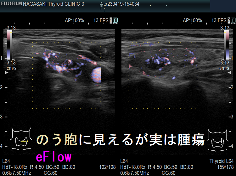 甲状腺のう胞に見えるが実は甲状腺腫瘍 eFlow 甲状腺のう胞に見えるが実は甲状腺腫瘍 eFlow