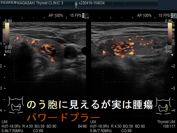 甲状腺のう胞に見えるが実は甲状腺腫瘍 パワードプラー 甲状腺のう胞に見えるが実は甲状腺腫瘍 パワードプラー