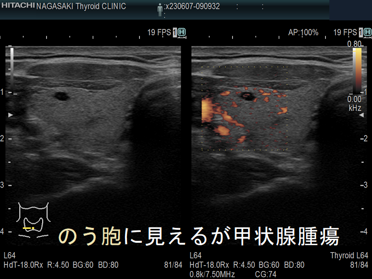 のう胞に見えるが甲状腺腫瘍 高感度パワードプラー のう胞に見えるが甲状腺腫瘍 高感度パワードプラー