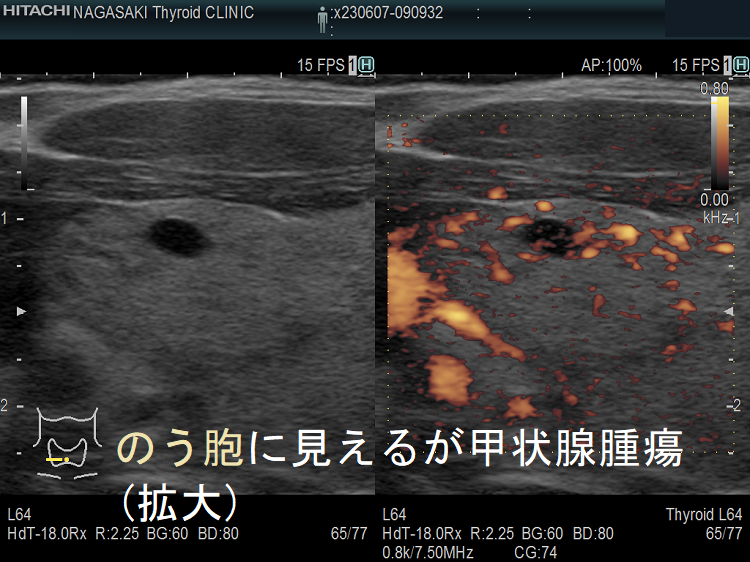 のう胞に見えるが甲状腺腫瘍 高感度パワードプラー(拡大) のう胞に見えるが甲状腺腫瘍 高感度パワードプラー(拡大)