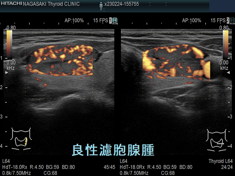 良性濾胞腺腫 超音波(エコー)画像 パワードプラーモード 良性濾胞腺腫 超音波(エコー)画像 パワードプラーモード
