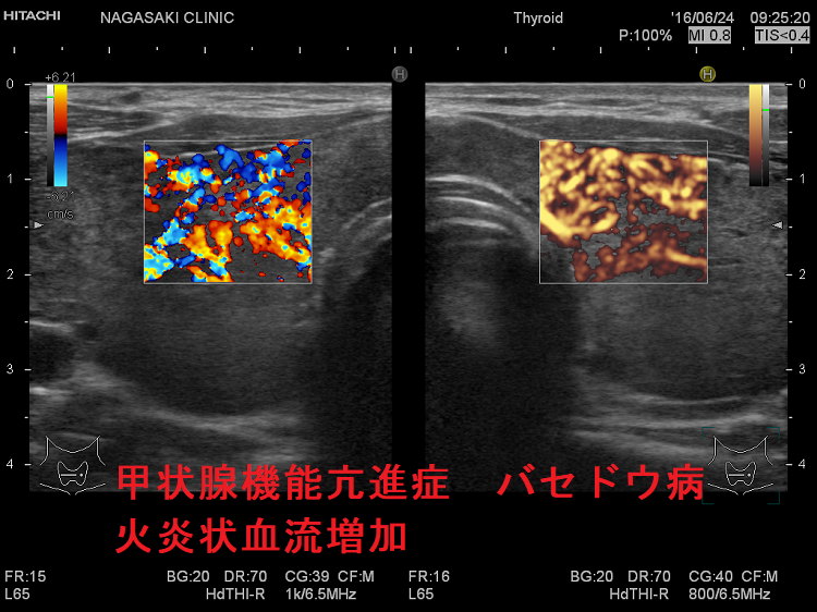 甲状腺機能亢進症/バセドウ病 火炎状血流増加 甲状腺機能亢進症バセドウ病 火炎状血流増加
