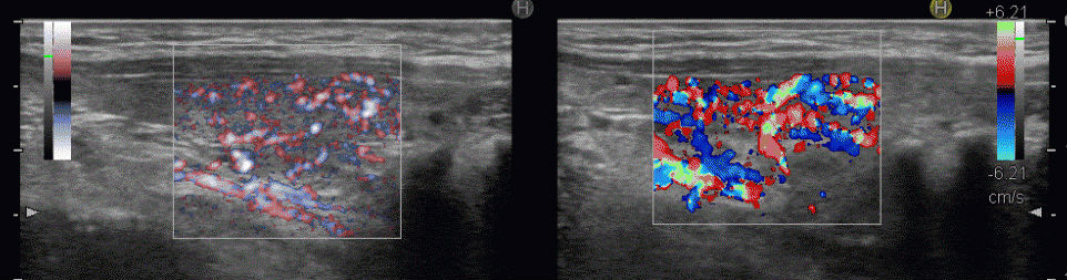 甲状腺機能亢進症/バセドウ病 eFlow(イー フロー) 甲状腺機能亢進症/バセドウ病 eFlow(イー フロー)