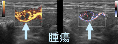 甲状腺腫瘍 eFlow(イー フロー) 甲状腺腫瘍 eFlow(イー フロー)