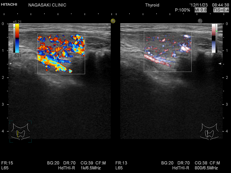 eFlow(イー フロー)と通常ドプラーの比較 eFlow(イー フロー)と通常ドプラーの比較