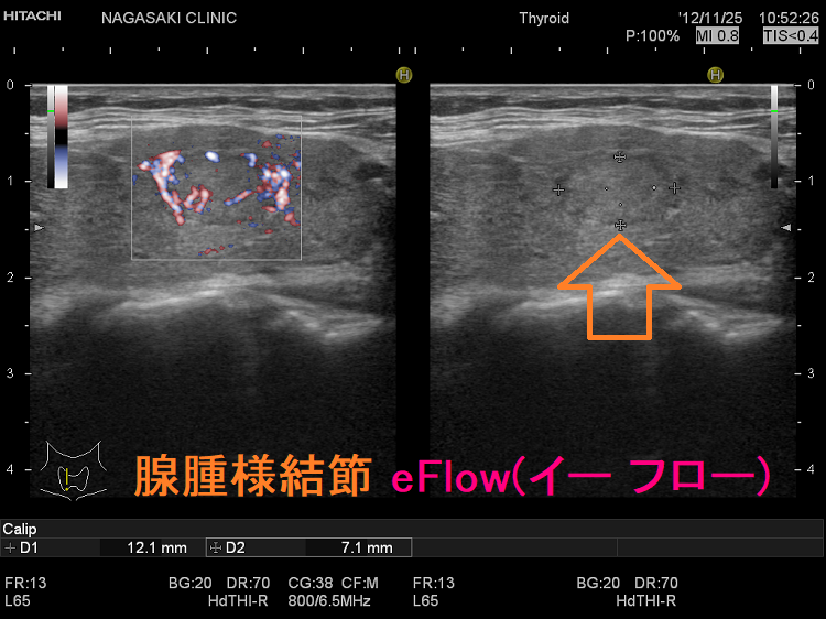 腺腫様結節 eFlow(イー フロー) 腺腫様結節 eFlow(イー フロー)