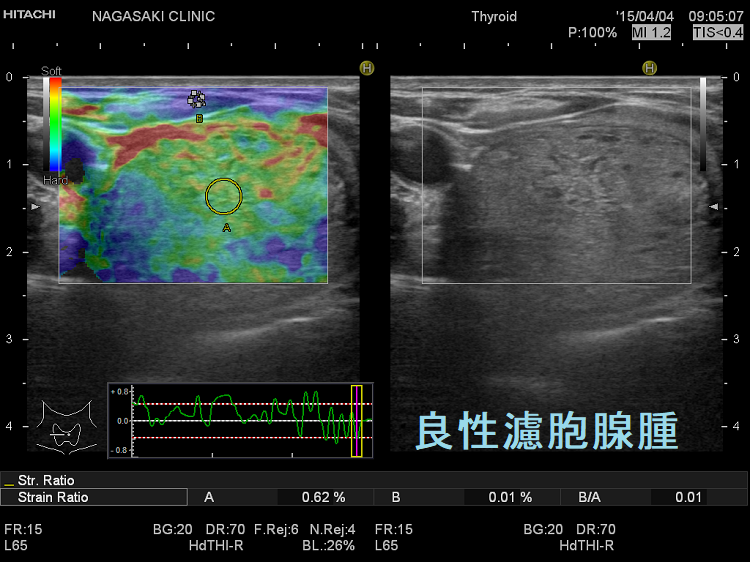 エラストグラフィー (甲状腺良性濾胞腺腫) エラストグラフィー (甲状腺良性濾胞腺腫)