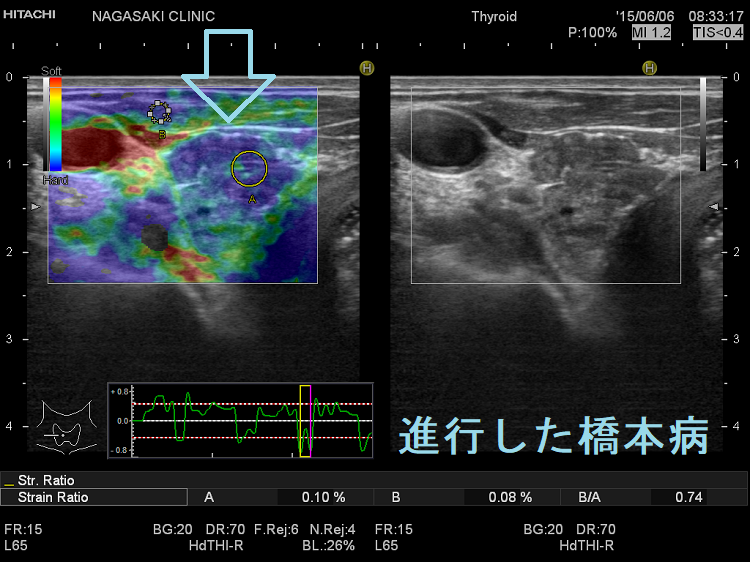 進行した橋本病 エラストグラフィー 進行した橋本病 エラストグラフィー
