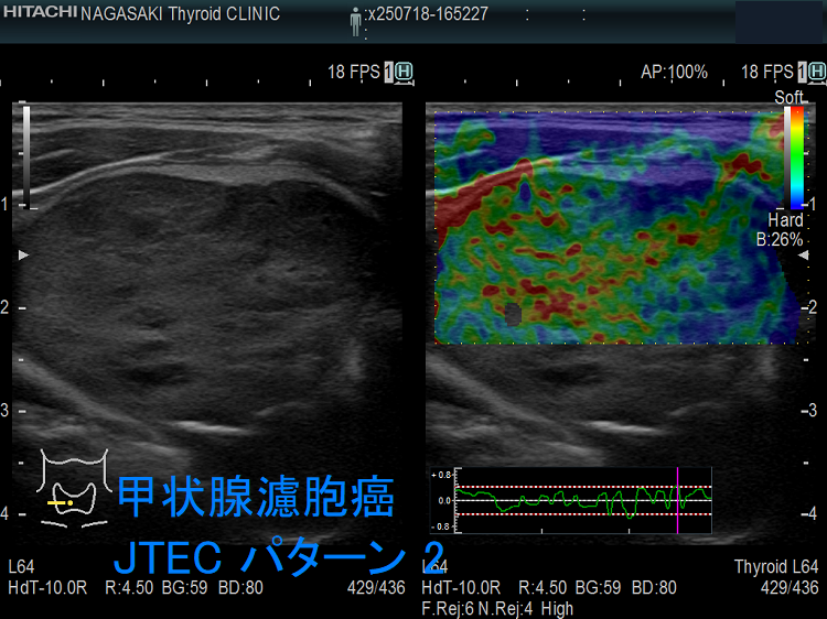 甲状腺濾胞癌 エラストグラフィー JTEC pattern 2 甲状腺濾胞癌 エラストグラフィー JTEC pattern 2