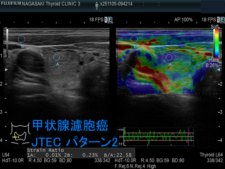 甲状腺濾胞癌 JTEC パターン2 甲状腺濾胞癌 JTEC パターン2