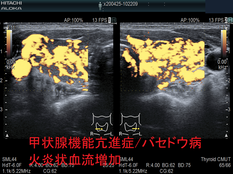 甲状腺機能亢進症/バセドウ病 火炎状血流増加 甲状腺機能亢進症 バセドウ病 火炎状血流増加