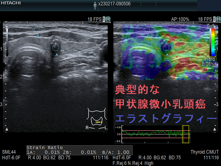 エラストグラフィー (甲状腺微小乳頭癌) エラストグラフィー (甲状腺微小乳頭癌)