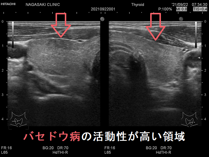 局所的に血流が多く、低エコーでバセドウ病の活動性が高い領域 局所的に血流が多く、低エコーでバセドウ病の活動性が高い領域