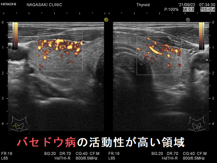 局所的に血流が多く、低エコーでバセドウ病の活動性が高い領域 局所的に血流が多く、低エコーでバセドウ病の活動性が高い領域
