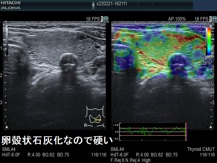被膜が石灰化した腫瘍 被膜が石灰化した腫瘍