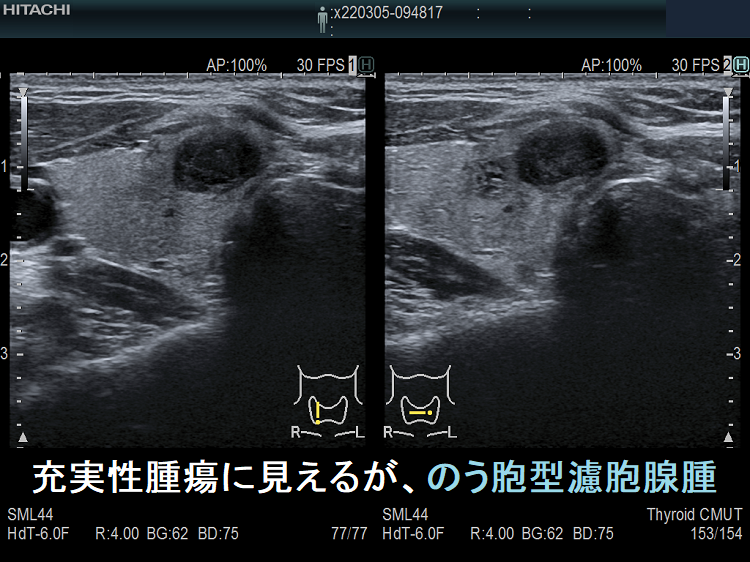 充実性腫瘍に見えるが、のう胞腺腫 充実性腫瘍に見えるが、のう胞腺腫