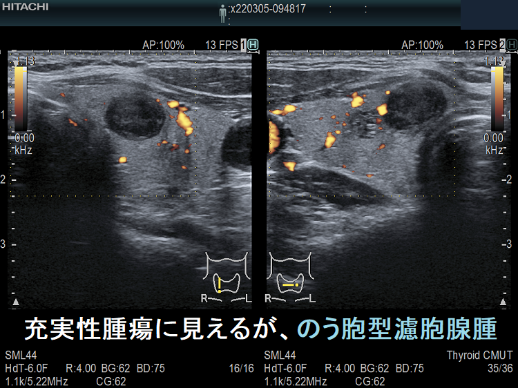 充実性腫瘍に見えるが、のう胞腺腫 充実性腫瘍に見えるが、のう胞腺腫