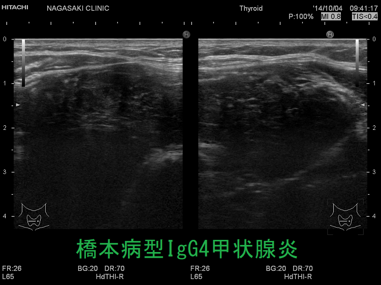 橋本病型IgG4甲状腺炎 超音波(エコー)画像 IgG4甲状腺炎(橋本病型IgG4甲状腺炎) 超音波(エコー)画像