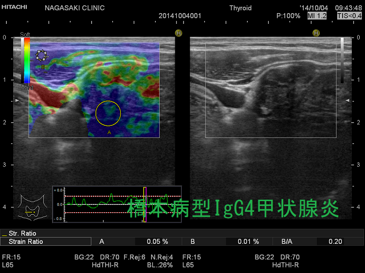 橋本病型IgG4甲状腺炎 エラストグラフィー 橋本病型IgG4甲状腺炎 エラストグラフィー