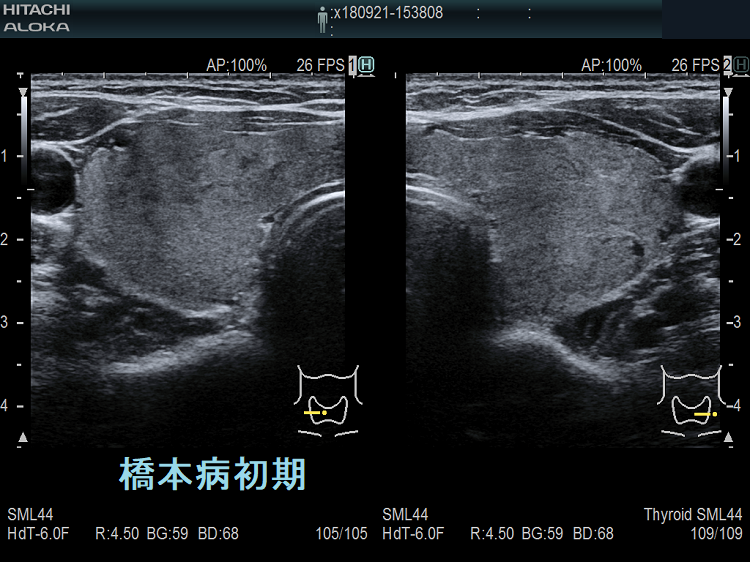橋本病初期エラストグラフィー 橋本病初期エラストグラフィー