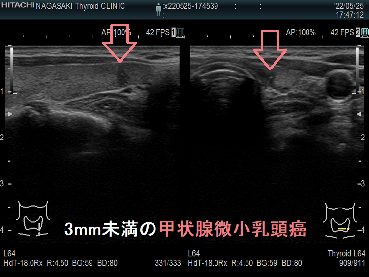 3mm未満の微小乳頭癌 超音波(エコー)画像 3mm未満の微小乳頭癌 超音波(エコー)画像