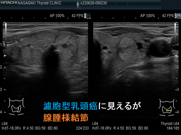 濾胞型乳頭癌に見えるが腺腫様結節 濾胞型乳頭癌に見えるが腺腫様結節