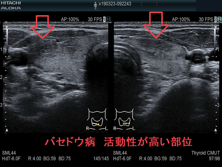 局所的に血流が多く、低エコーでバセドウ病の活動性が高い領域 局所的に血流が多く、低エコーでバセドウ病の活動性が高い領域