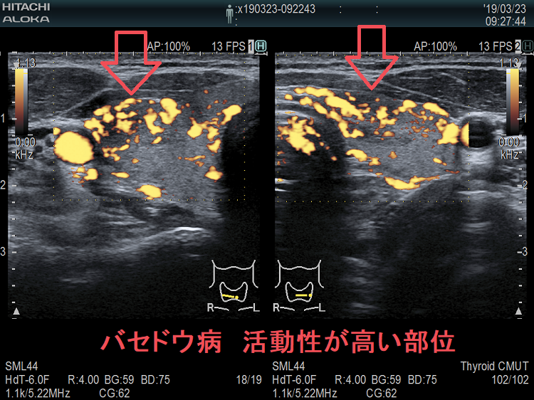 局所的に血流が多く、低エコーでバセドウ病の活動性が高い領域 ドプラーモード 局所的に血流が多く、低エコーでバセドウ病の活動性が高い領域 ドプラーモード