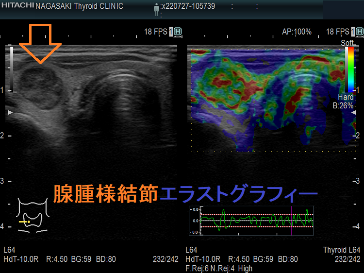 腺腫様結節 エラストグラフィー 腺腫様結節 エラストグラフィー