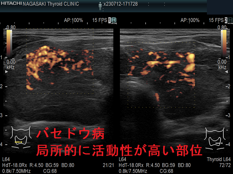 バセドウ病 局所的に活動性が高い部位 ドプラーモード バセドウ病 局所的に活動性が高い部位 ドプラーモード