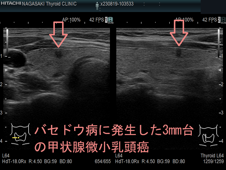 バセドウ病に発生した3mm台の甲状腺微小乳頭癌 超音波(エコー)画像 バセドウ病に発生した3mm台の甲状腺微小乳頭癌 超音波(エコー)画像