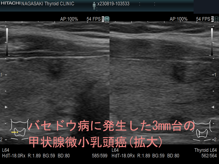 バセドウ病に発生した3mm台の甲状腺微小乳頭癌(拡大) 超音波(エコー)画像 バセドウ病に発生した3mm台の甲状腺微小乳頭癌(拡大) 超音波(エコー)画像