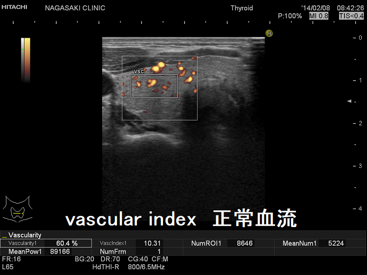 vascular index 正常血流 vascular index 正常血流