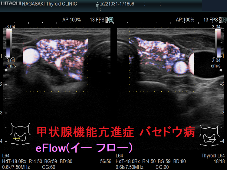 甲状腺機能亢進症 バセドウ病 eFlow(イー フロー) 甲状腺機能亢進症 バセドウ病 eFlow(イー フロー)