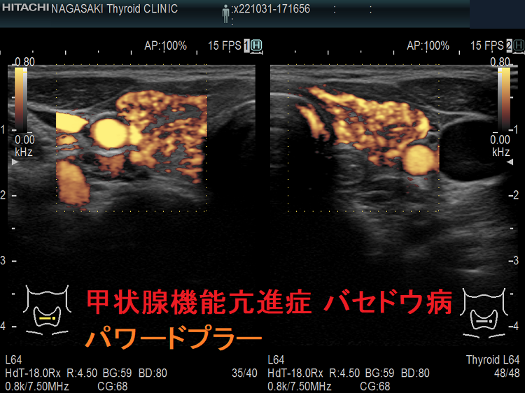 甲状腺機能亢進症 バセドウ病 パワードプラー 甲状腺機能亢進症 バセドウ病 パワードプラー