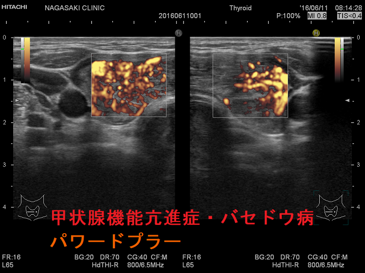 甲状腺機能亢進症・バセドウ病 パワードプラー 甲状腺機能亢進症・バセドウ病 パワードプラー
