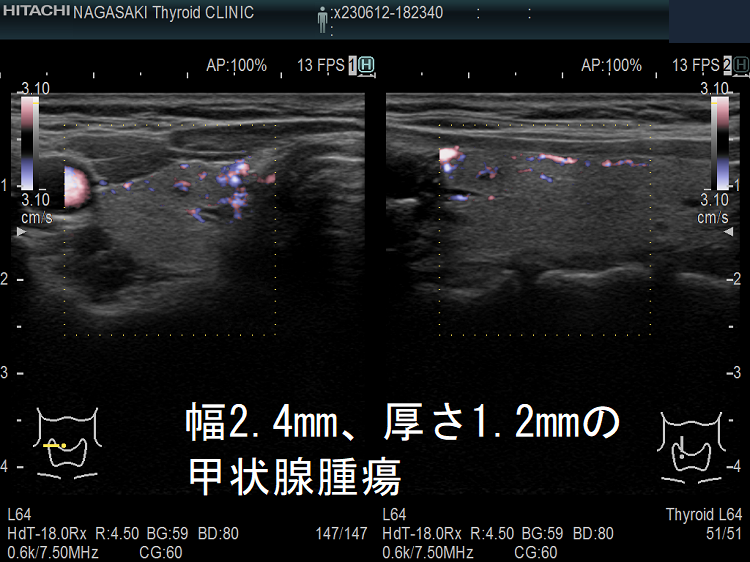 幅2.4mm、厚さ1.2mmの甲状腺腫瘍 ドプラーモード 幅2.4mm、厚さ1.2mmの甲状腺腫瘍 ドプラーモード
