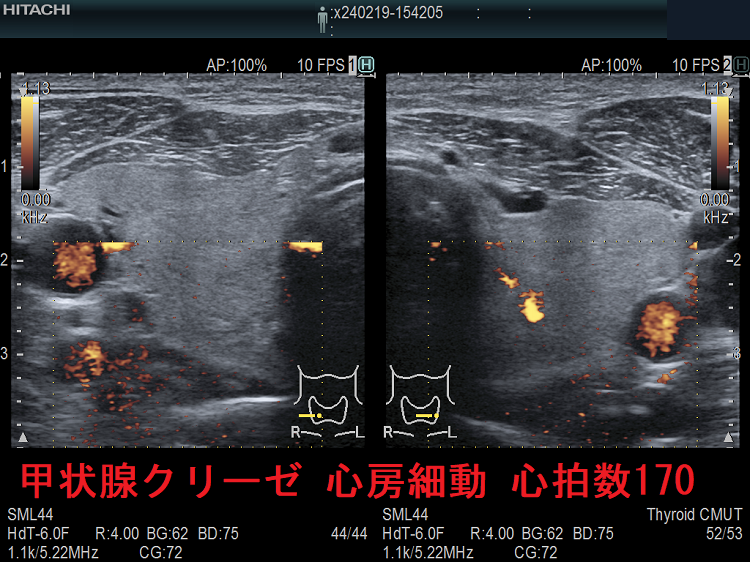 甲状腺クリーゼ 心房細動 心拍数170 甲状腺クリーゼ 心房細動 心拍数170
