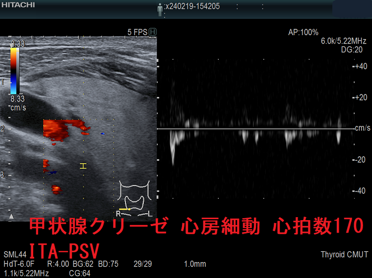 甲状腺クリーゼ 心房細動 心拍数170 ITA-PSV 甲状腺クリーゼ 心房細動 心拍数170 ITA-PSV