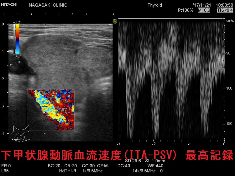 甲状腺動脈血流速度(ITA-PSV) 最高記録 下甲状腺動脈血流速度(ITA-PSV) 最高記録