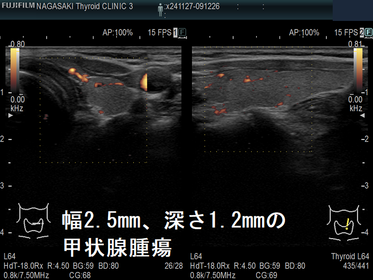 幅2.5mm、深さ1.2mmの甲状腺腫瘍 超音波(エコー)画像 パワードプラー 幅2.5mm、深さ1.2mmの甲状腺腫瘍 超音波(エコー)画像 パワードプラー