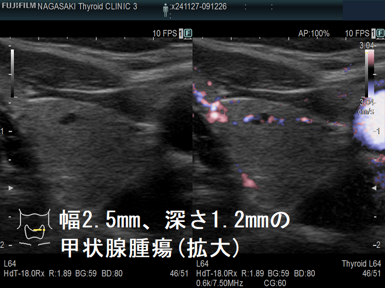 幅2.5mm、深さ1.2mmの甲状腺腫瘍 超音波(エコー)画像 パワードプラー 幅2.5mm、深さ1.2mmの甲状腺腫瘍 超音波(エコー)画像eFlow(拡大)