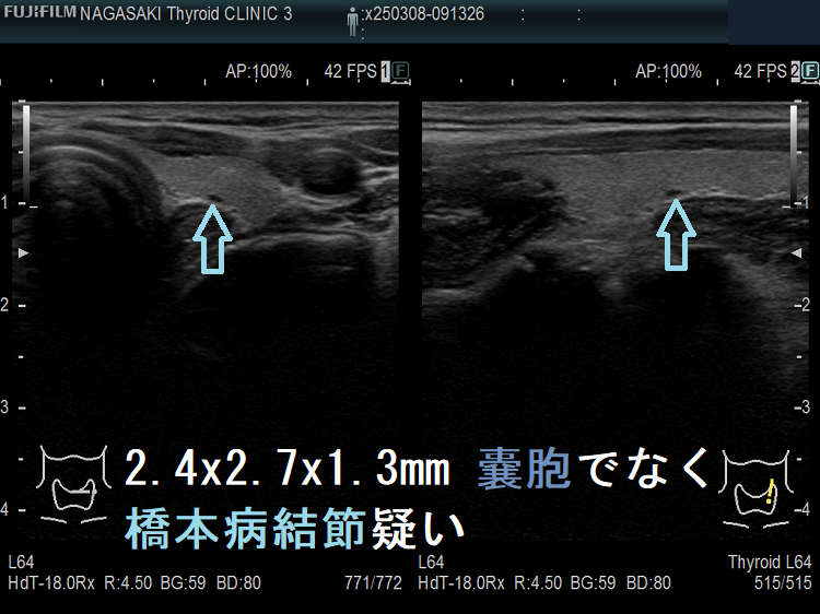 2.4 x 2.7 x 1.3 mm 甲状腺のう胞(甲状腺嚢胞)でなく橋本病結節疑い 2.4 x 2.7 x 1.3 mm 甲状腺のう胞(甲状腺嚢胞)でなく橋本病結節疑い