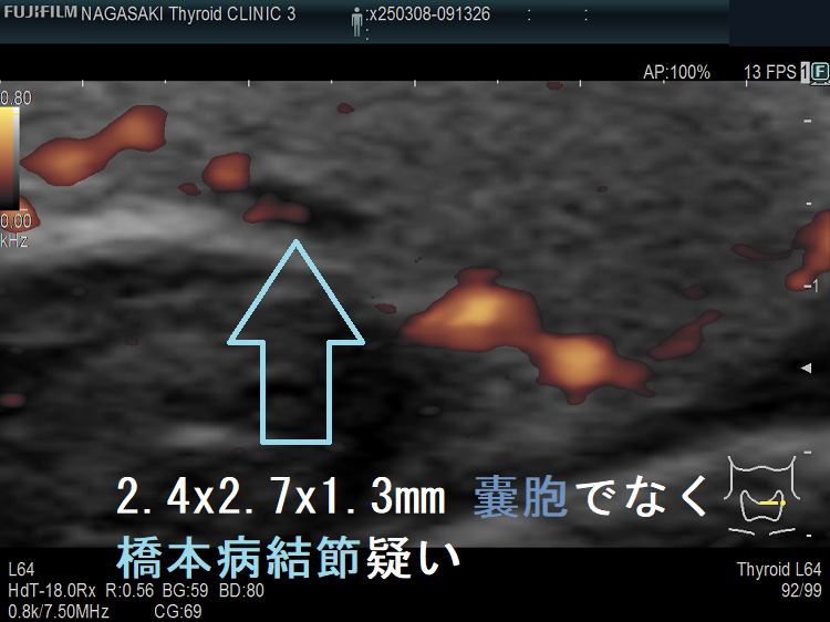 2.4 x 2.7 x 1.3 mm 甲状腺のう胞(甲状腺嚢胞)でなく橋本病結節疑い ドプラーモード 2.4 x 2.7 x 1.3 mm 甲状腺のう胞(甲状腺嚢胞)でなく橋本病結節疑い ドプラーモード